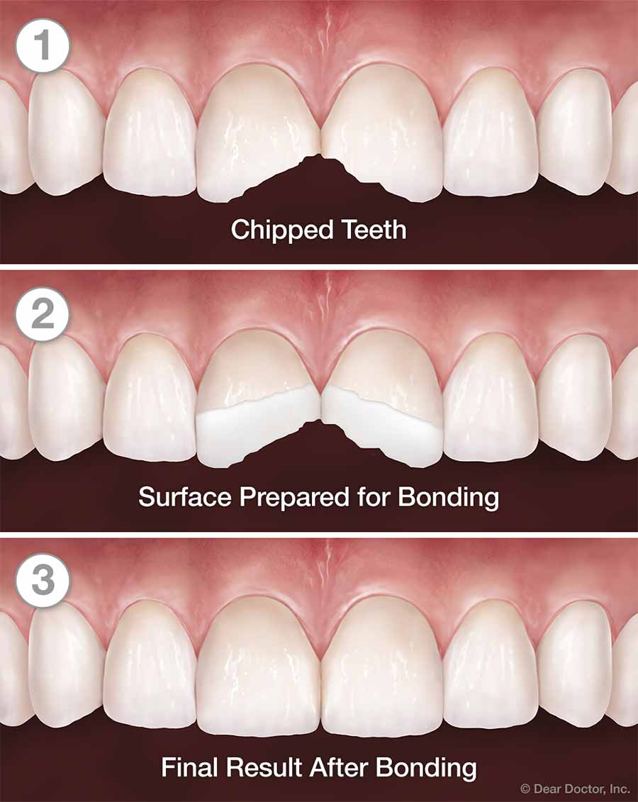 Tooth Bonding Step by Step.